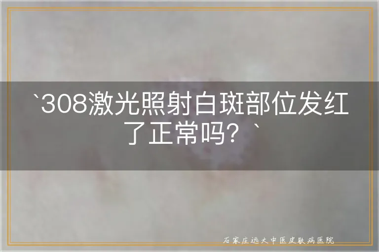 `308激光照射白斑部位发红了正常吗？`