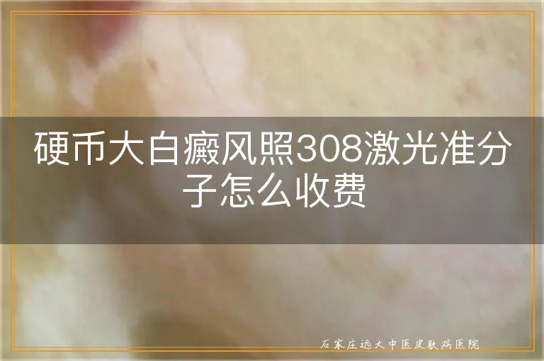 硬币大白癜风照308激光准分子怎么收费