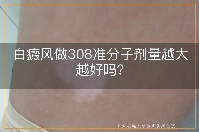 白癜风做308准分子剂量越大越好吗？