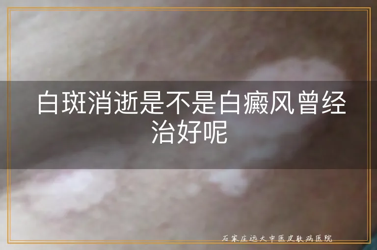 白斑消逝是不是白癜风曾经治好呢