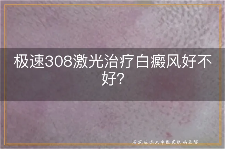 极速308激光治疗白癜风好不好？