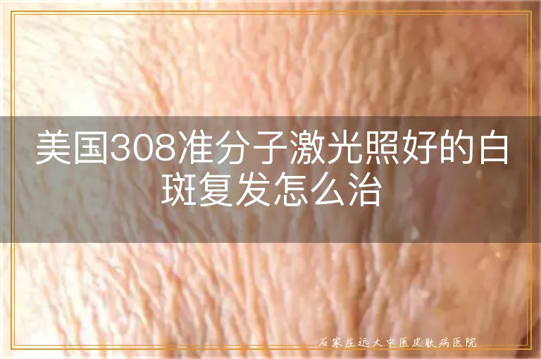 美国308准分子激光照好的白斑复发怎么治