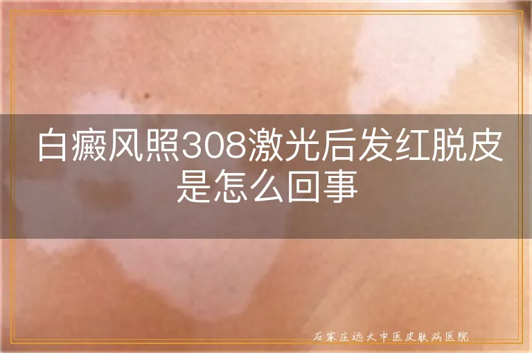 白癜风照308激光后发红脱皮是怎么回事