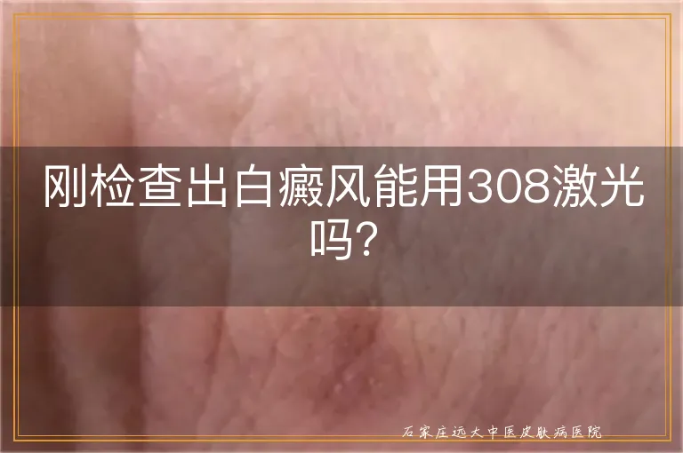 刚检查出白癜风能用308激光吗？