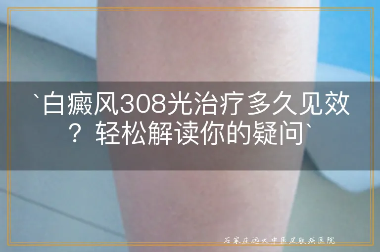 `白癜风308光治疗多久见效？轻松解读你的疑问`