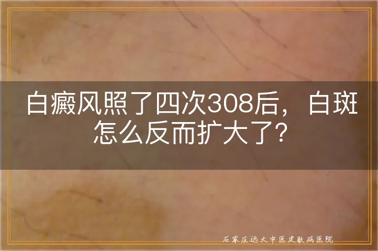 白癜风照了四次308后，白斑怎么反而扩大了？