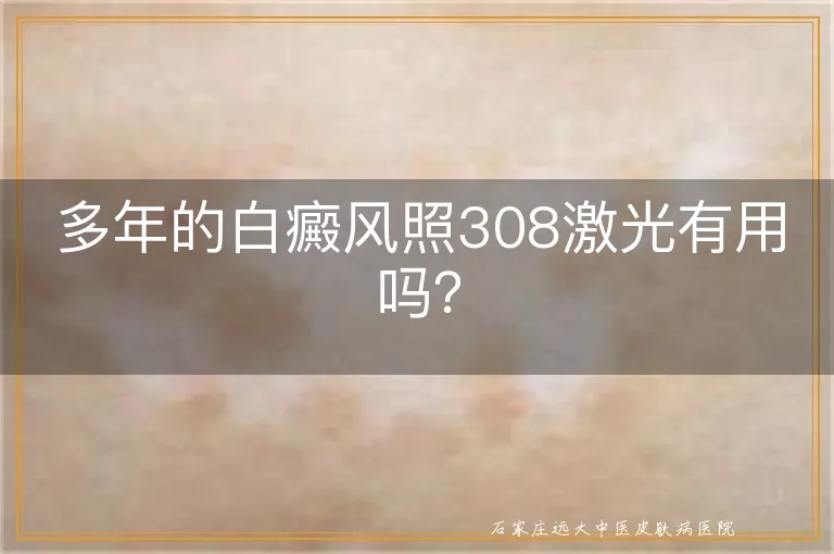 多年的白癜风照308激光有用吗？