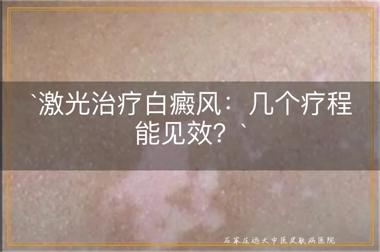 `激光治疗白癜风：几个疗程能见效？`