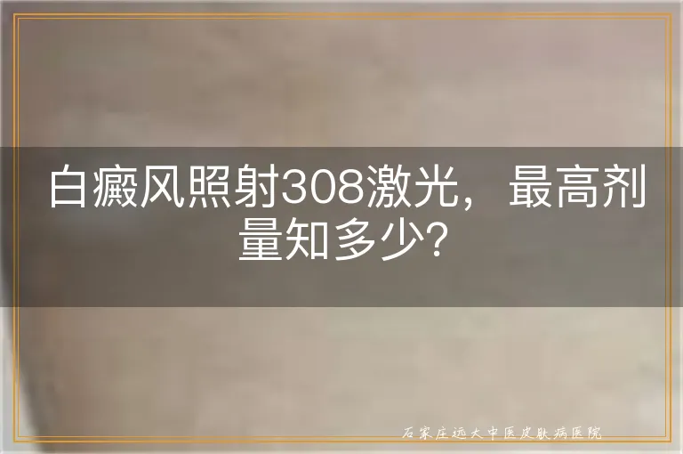 白癜风照射308激光，最高剂量知多少？