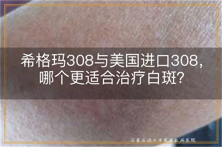 希格玛308与美国进口308，哪个更适合治疗白斑？