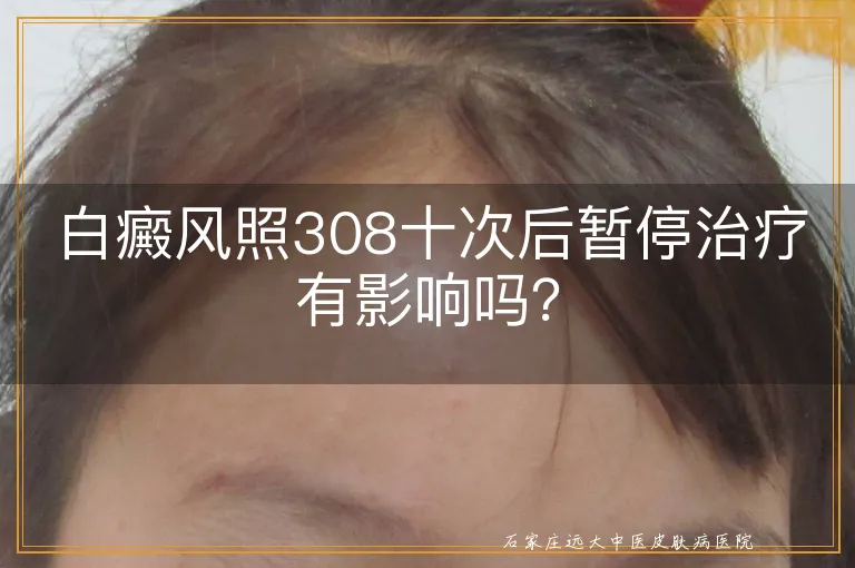 白癜风照308十次后暂停治疗有影响吗？