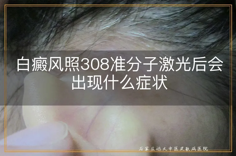 白癜风照308准分子激光后会出现什么症状