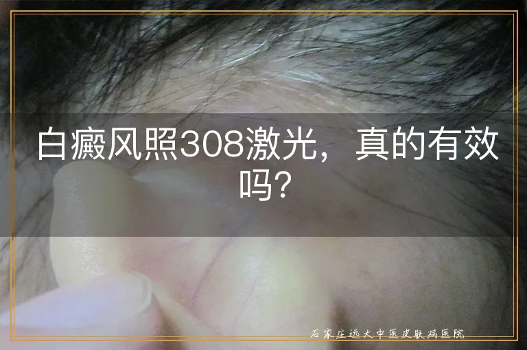 白癜风照308激光，真的有效吗？