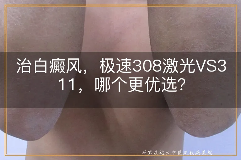 治白癜风，极速308激光VS311，哪个更优选？