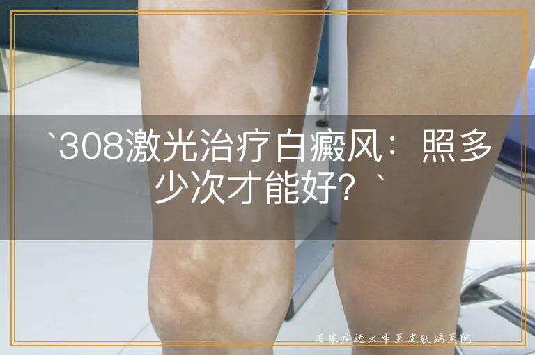 `308激光治疗白癜风：照多少次才能好？`