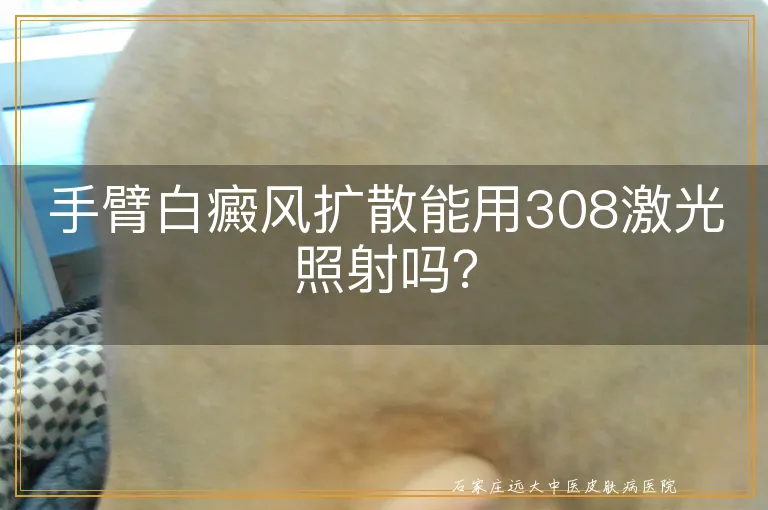 手臂白癜风扩散能用308激光照射吗？