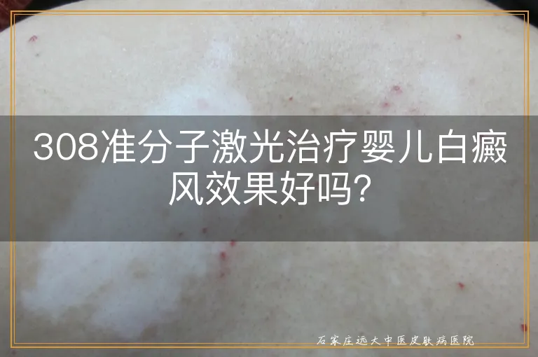 308准分子激光治疗婴儿白癜风效果好吗？