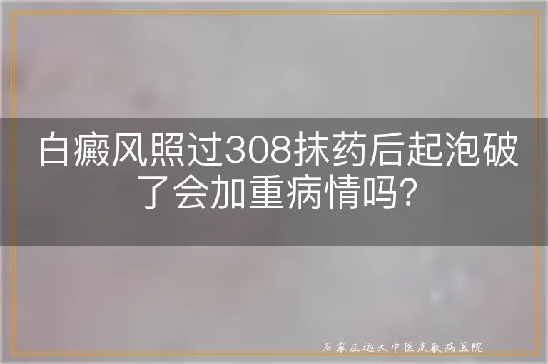 白癜风照过308抹药后起泡破了会加重病情吗？