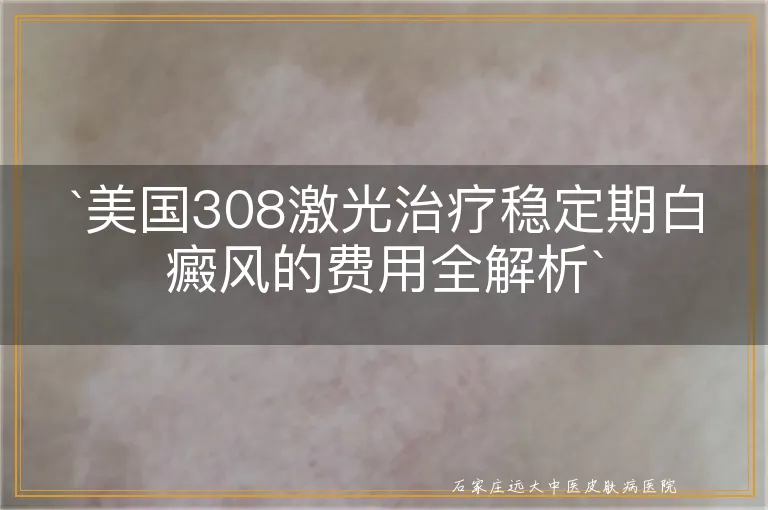 `美国308激光治疗稳定期白癜风的费用全解析`