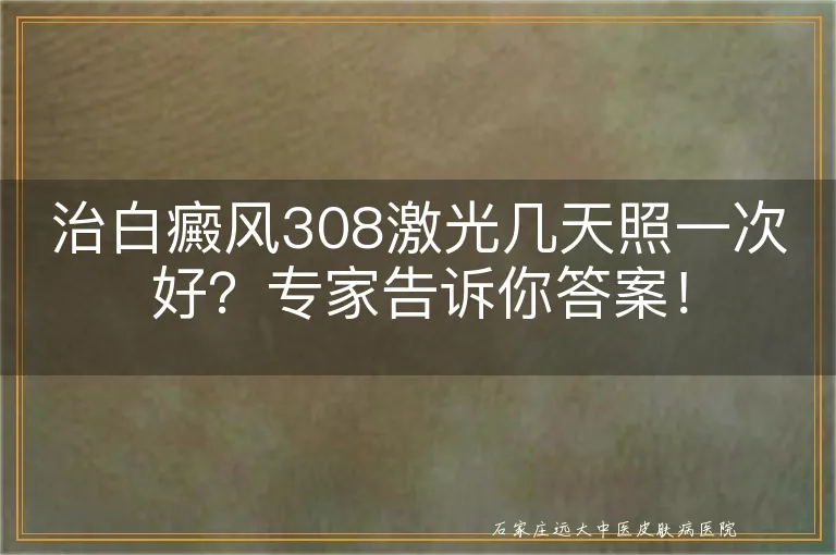 治白癜风308激光几天照一次好？专家告诉你答案！