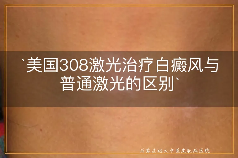 `美国308激光治疗白癜风与普通激光的区别`