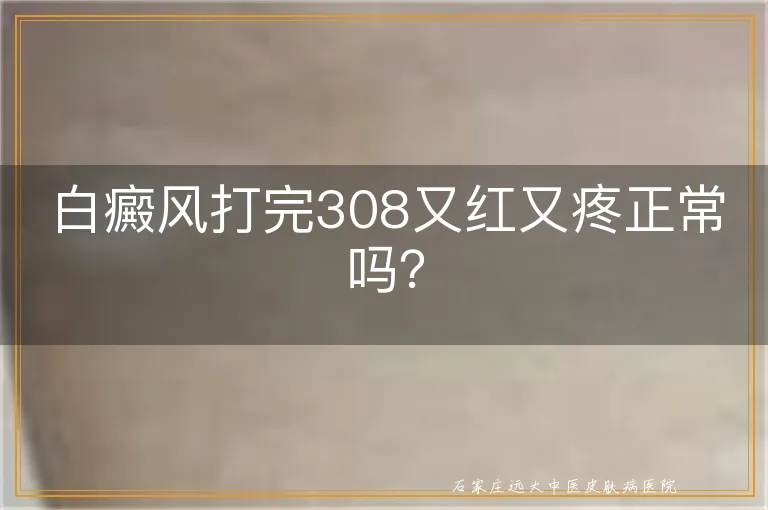 白癜风打完308又红又疼正常吗？