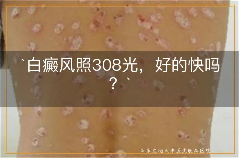 `白癜风照308光，好的快吗？`