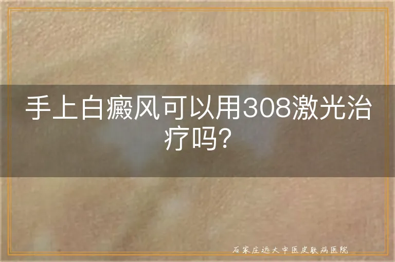 手上白癜风可以用308激光治疗吗？