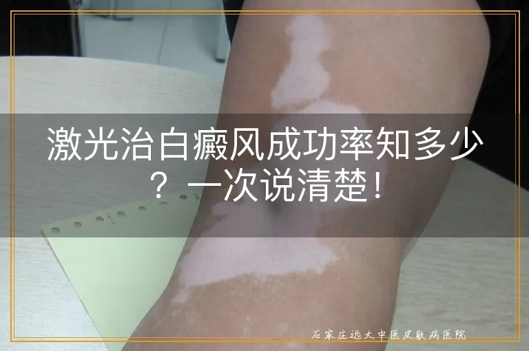 激光治白癜风成功率知多少？一次说清楚！