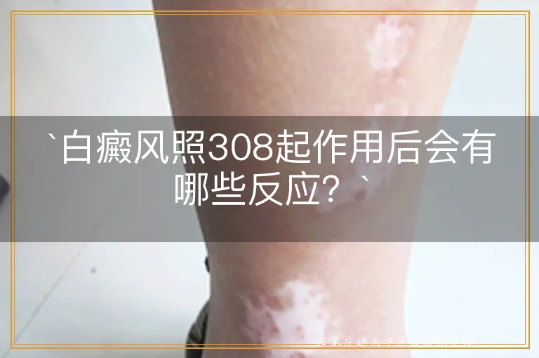 `白癜风照308起作用后会有哪些反应？`