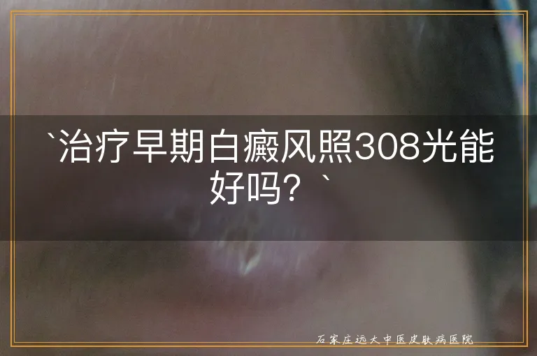 `治疗早期白癜风照308光能好吗？`