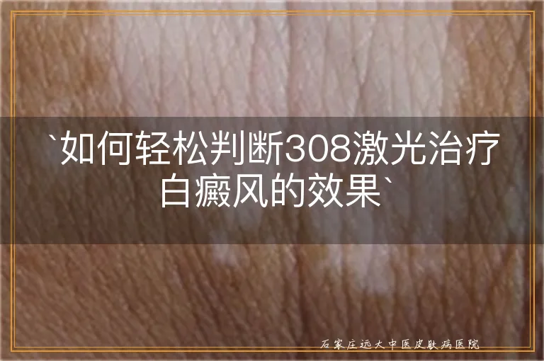 `如何轻松判断308激光治疗白癜风的效果`