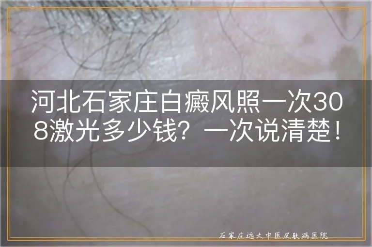 河北石家庄白癜风照一次308激光多少钱？一次说清楚！