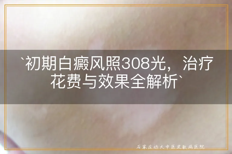 `初期白癜风照308光，治疗花费与效果全解析`