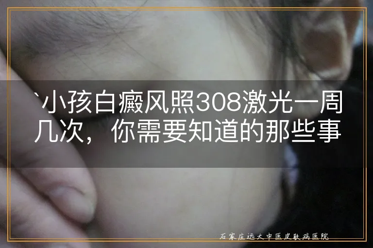 `小孩白癜风照308激光一周几次，你需要知道的那些事`