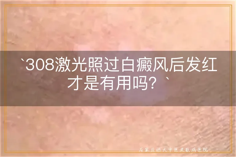 `308激光照过白癜风后发红才是有用吗？`