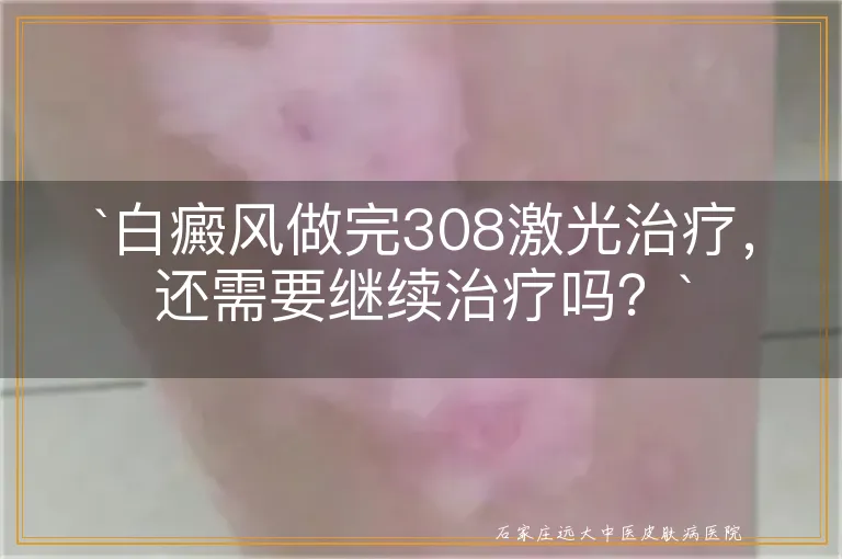 `白癜风做完308激光治疗，还需要继续治疗吗？`