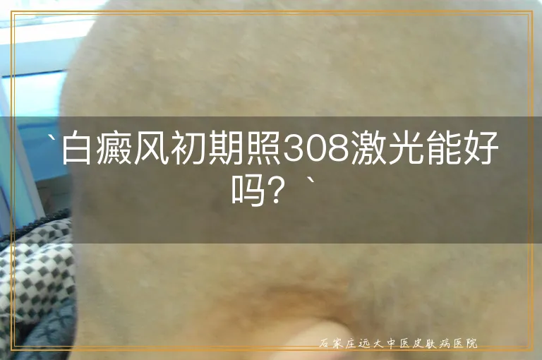 `白癜风初期照308激光能好吗？`