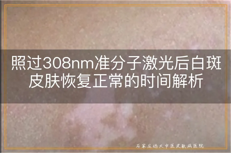 照过308nm准分子激光后白斑皮肤恢复正常的时间解析