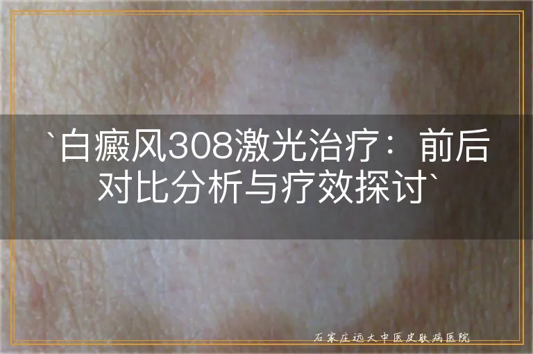 `白癜风308激光治疗：前后对比分析与疗效探讨`