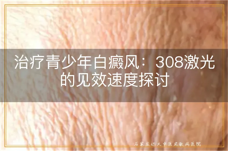 治疗青少年白癜风：308激光的见效速度探讨