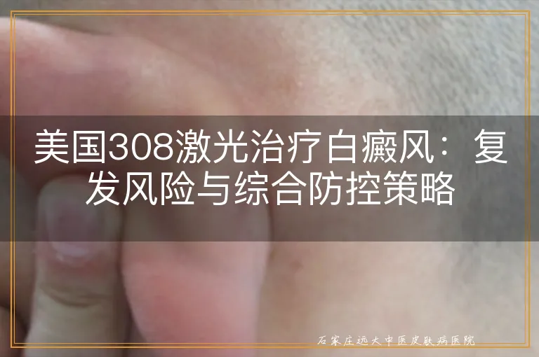 美国308激光治疗白癜风：复发风险与综合防控策略