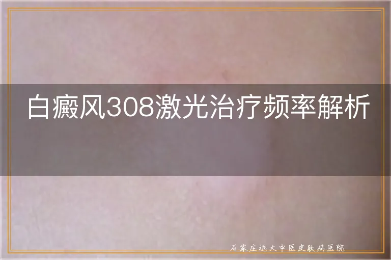 白癜风308激光治疗频率解析