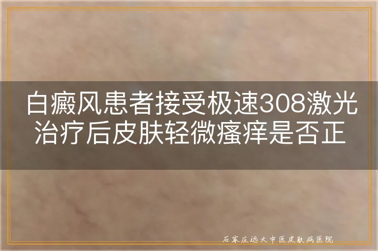 白癜风患者接受极速308激光治疗后皮肤轻微瘙痒是否正常