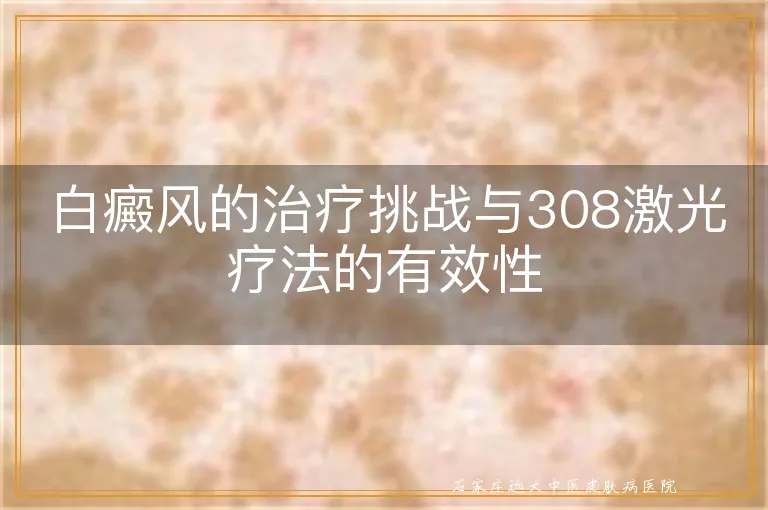 白癜风的治疗挑战与308激光疗法的有效性