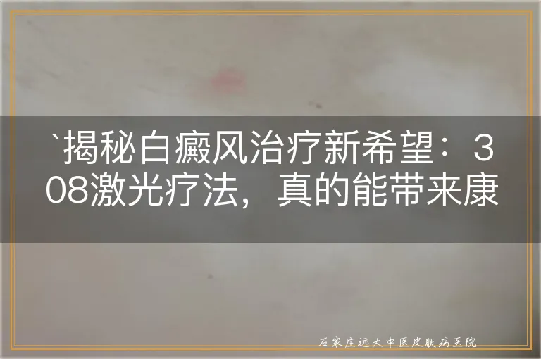 揭秘白癜风治疗新希望：308激光疗法，真的能带来康复曙光吗？