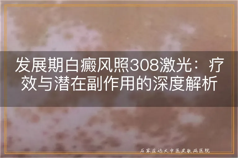 发展期白癜风照308激光：疗效与潜在副作用的深度解析