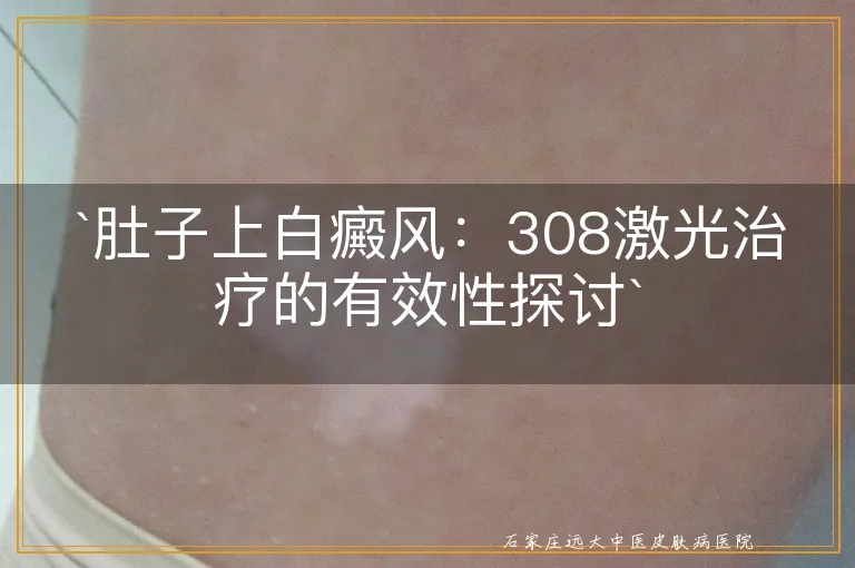 肚子上白癜风：308激光治疗的有效性探讨