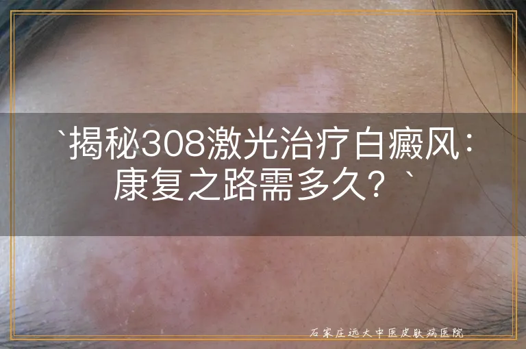 揭秘308激光治疗白癜风：康复之路需多久？