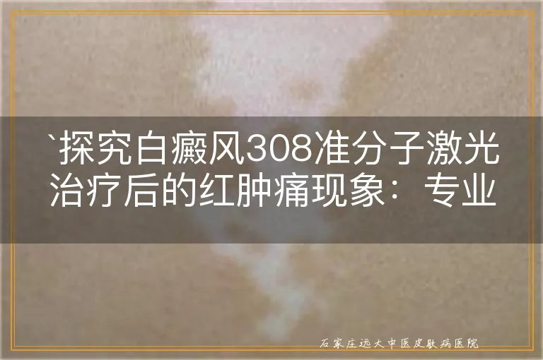 探究白癜风308准分子激光治疗后的红肿痛现象：专业解析与应对策略